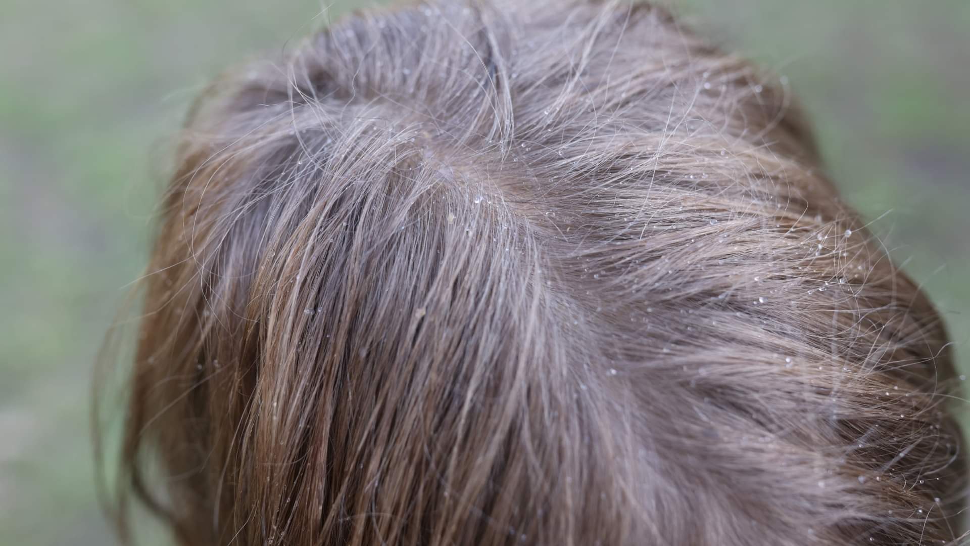 Hair Care Myths and Facts Can Rainwater Really Cause Head Lice
