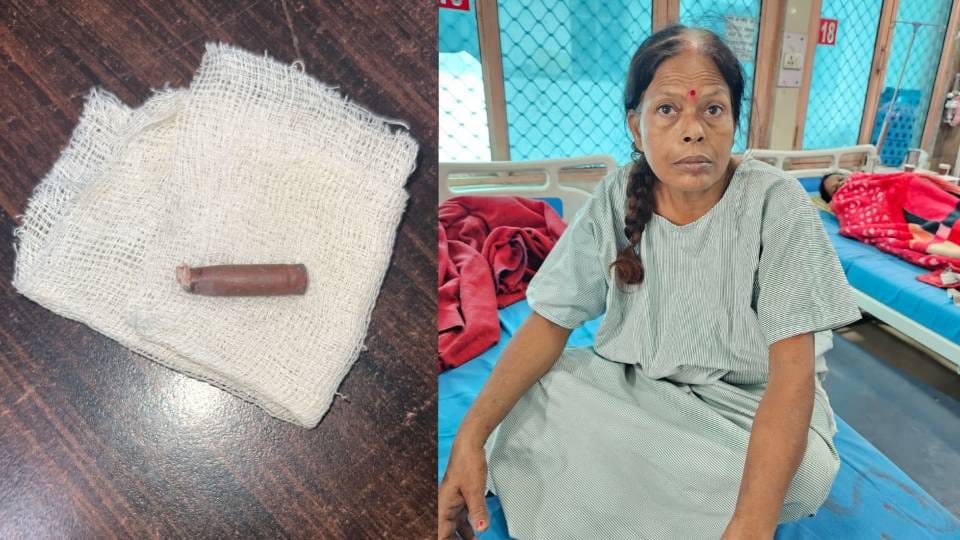 bullet stuck in spine of woman for 35 years In Lucknow doctors removed it through surgery