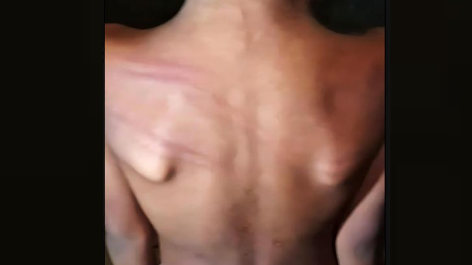 Kannauj: Teacher beats student with a stick, marks on her back