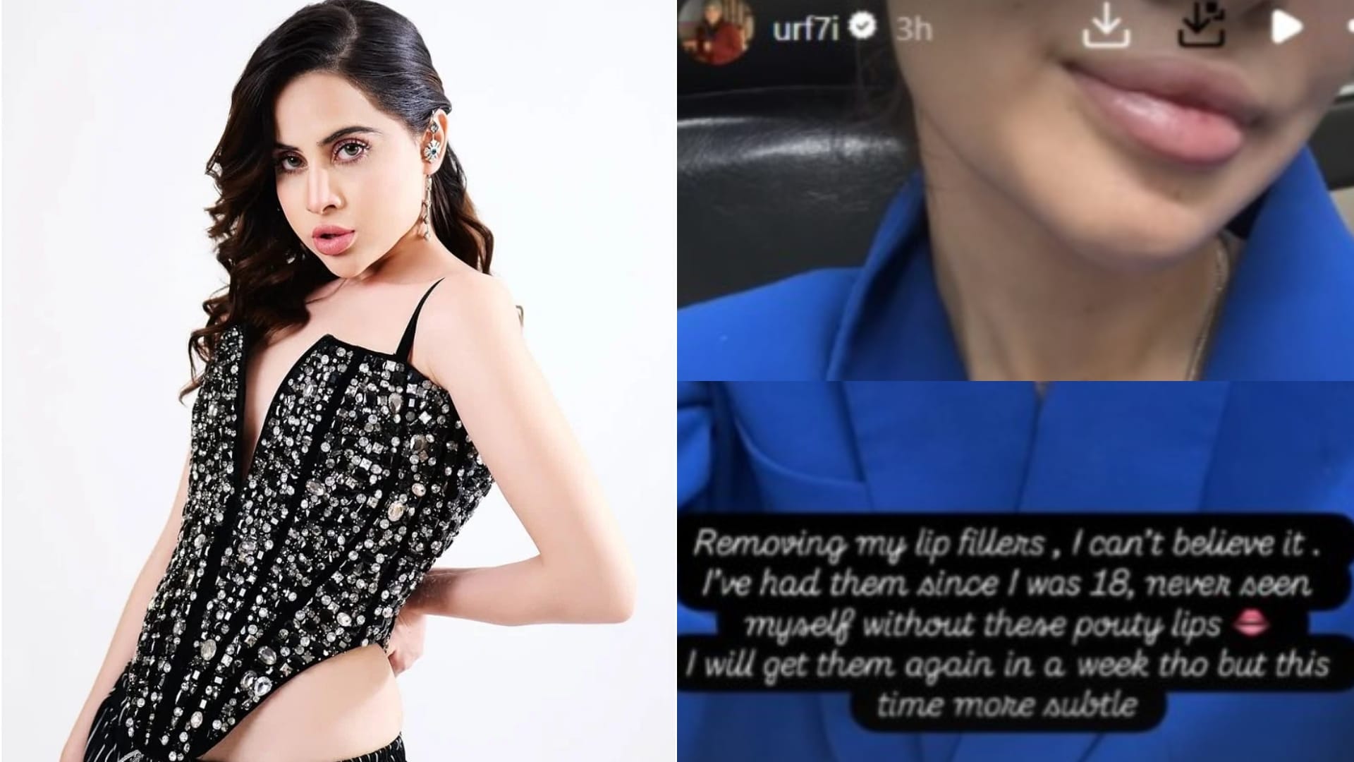 Uorfi Javed Got the fillers Removed from Her lips