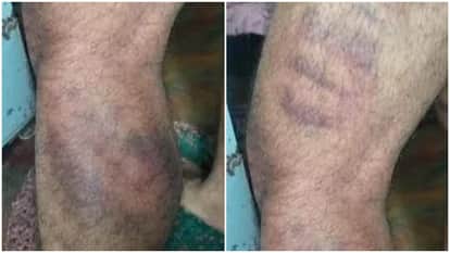 Man Alleges Night-long Police Torture in Sidhi Over Theft Suspicion