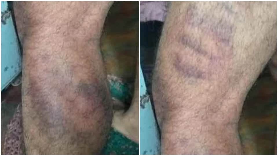 कई दिन अस्पताल में भर्ती रहा युवक।