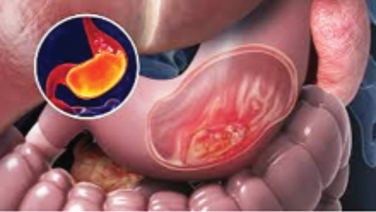 Report: More than one crore children born between 2008 and 2017 risk of gastric cancer