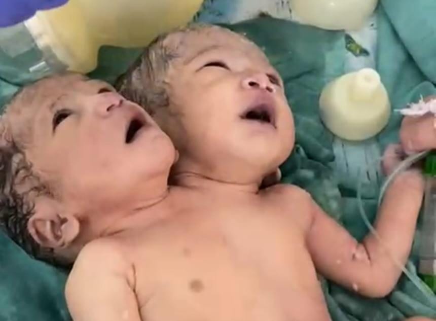 Indore News: Twins with conjoined heads were born in Indore's MTH hospital