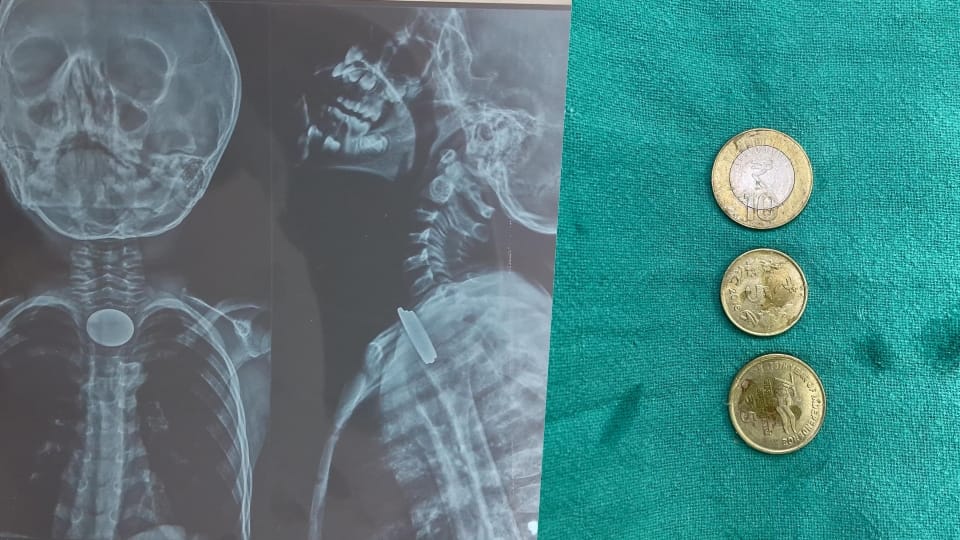 Three coins got stuck in the child's food pipe, he was treated in Rohini's government hospital