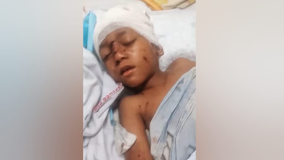 Ten dogs mauled seven year old boy ate skin of half of his head in ambala