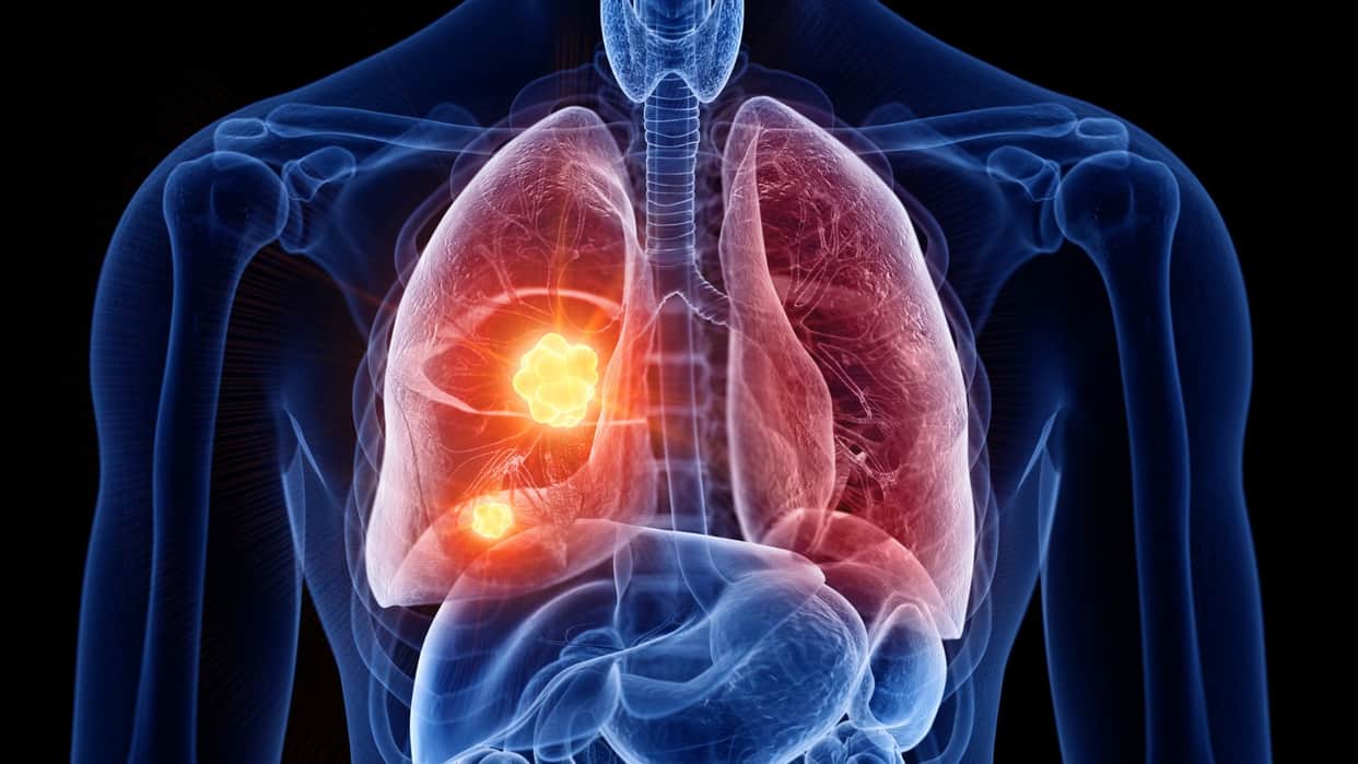 World Lung Cancer Day 2025 Know Significance History and This Year Theme