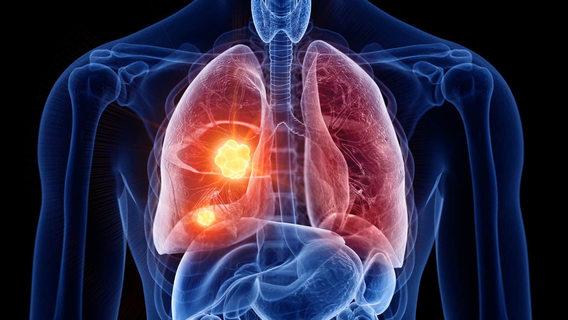 World Cancer Day 2026: Early Symptoms of Lung Cancer in Non-Smokers and Prevention Tips