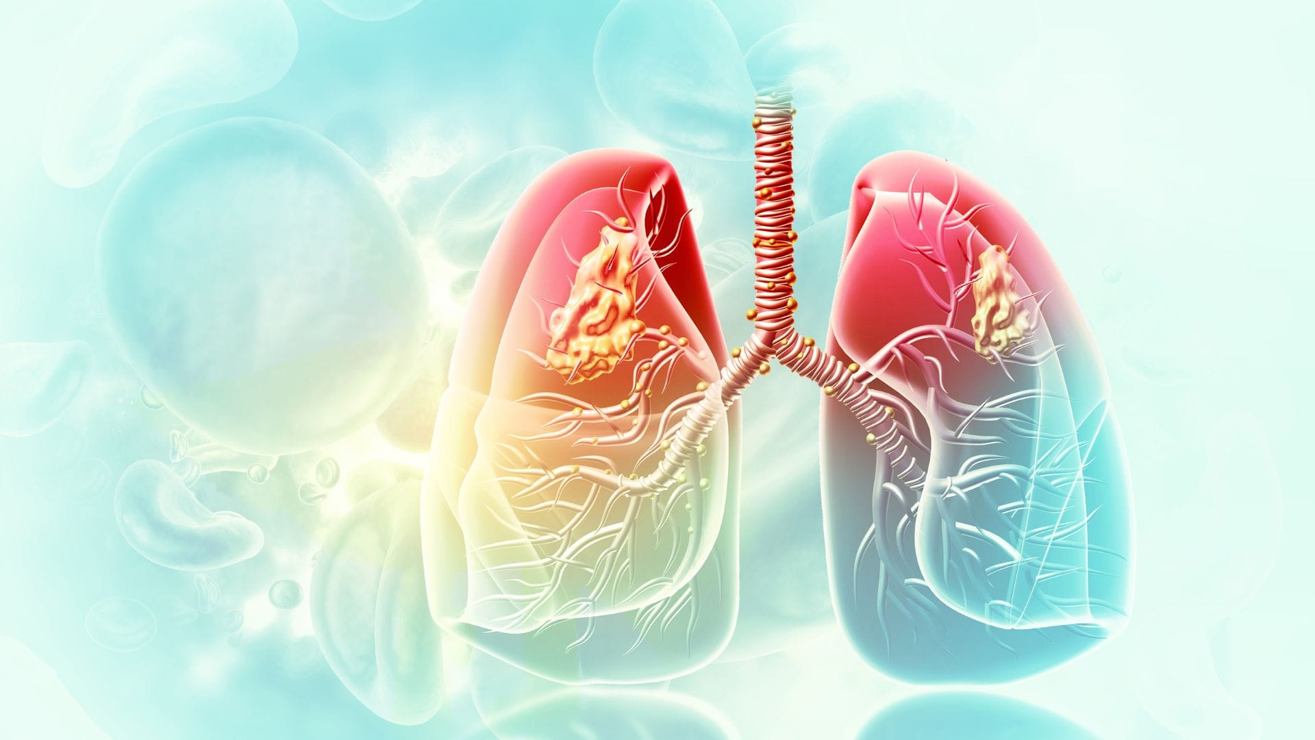 Air Pollution Health Tips Long-Term Exposure to Polluted Air Increases Cancer Risk Study report