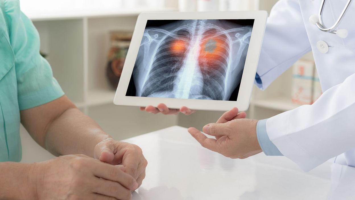 World Lung Cancer Day 2025: 7 संकेतों से चेतावनी देता है फेफड़ों का कैंसर, आप भी करें पहचान
