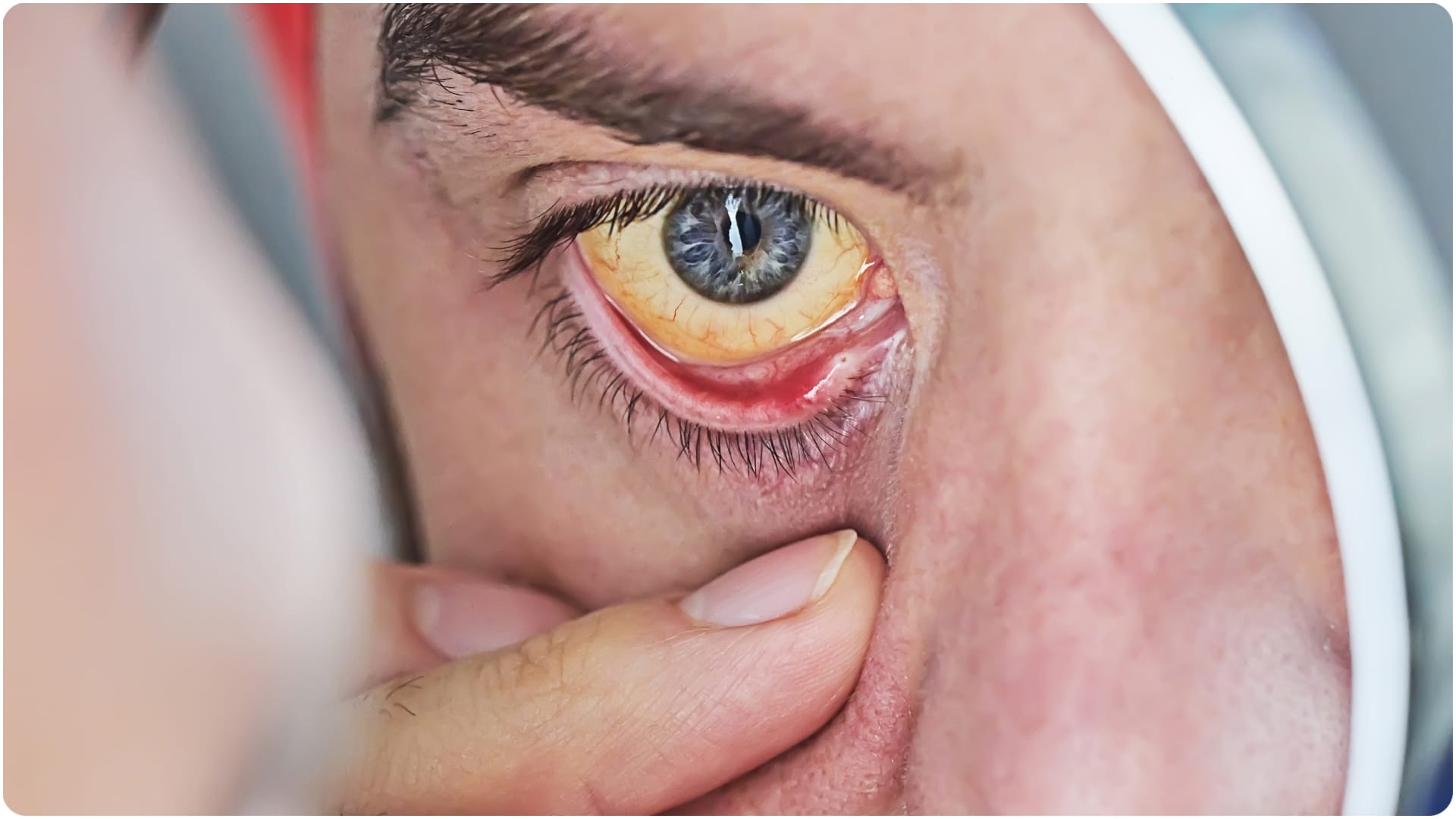 eyes can reveal serious health issues Changes in Eyes Signals high cholesterol and liver disease