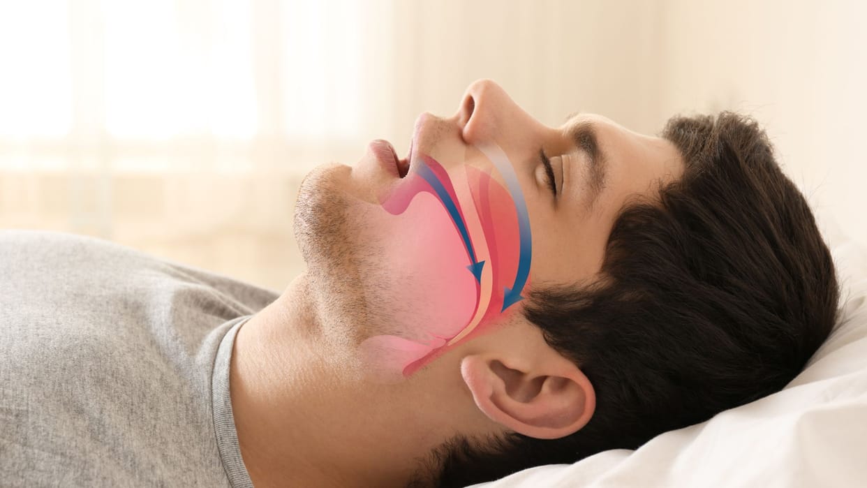 Winter Snoring Crisis: Rising Risk for Heart and Brain, Over 100 Patients Visiting Hospitals Daily