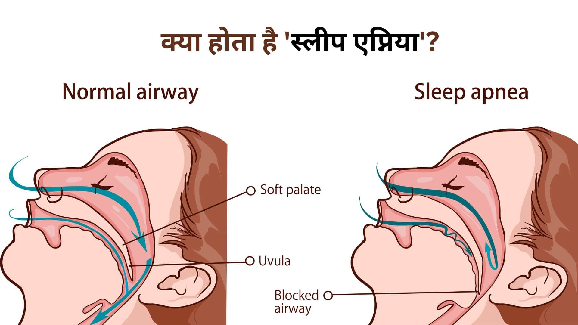 Why Children Snore Pediatrician Explains Causes Like Adenoids and Obesity