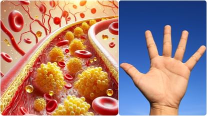 high cholesterol symptoms on hand and eyes you should look tendon xanthomata