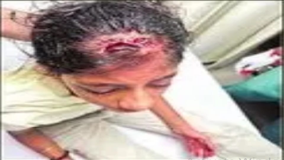 Noida: Stone falls on girl's head from 25th floor in Amrapali Platinum Society, gets 10 stitches