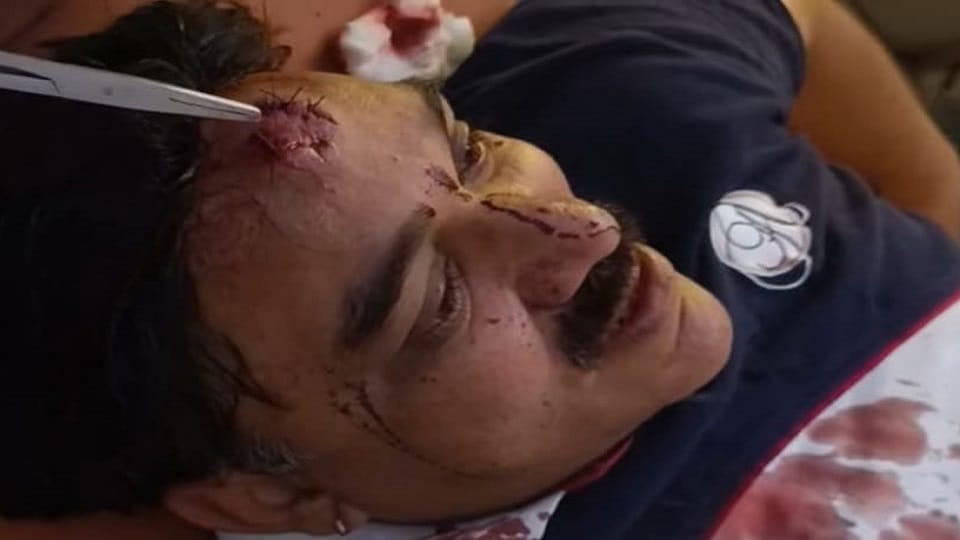 Saharanpur: BJP councilor started hitting his forehead with a brick, got bleeding, got nine stitches