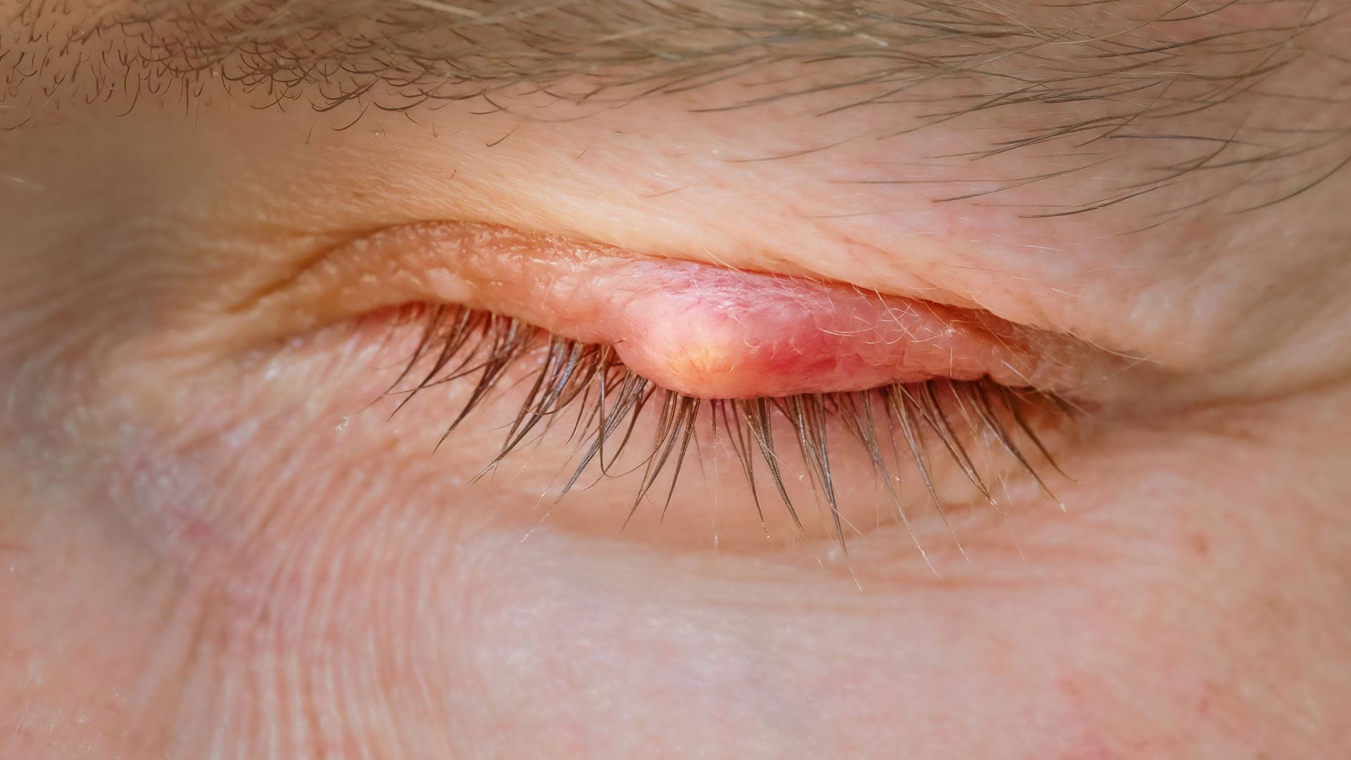 Why do boils and pimples appear on the body Know the three major reasons behind this