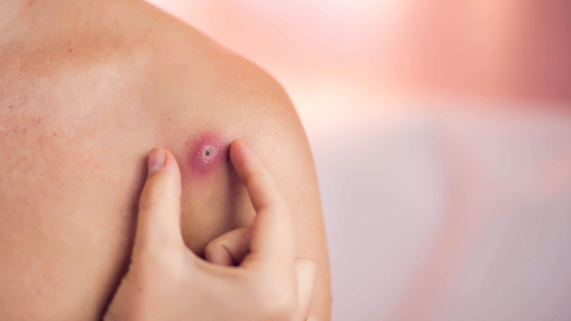Difference Between Lumps, Swelling, and Pimples: When to See a Doctor