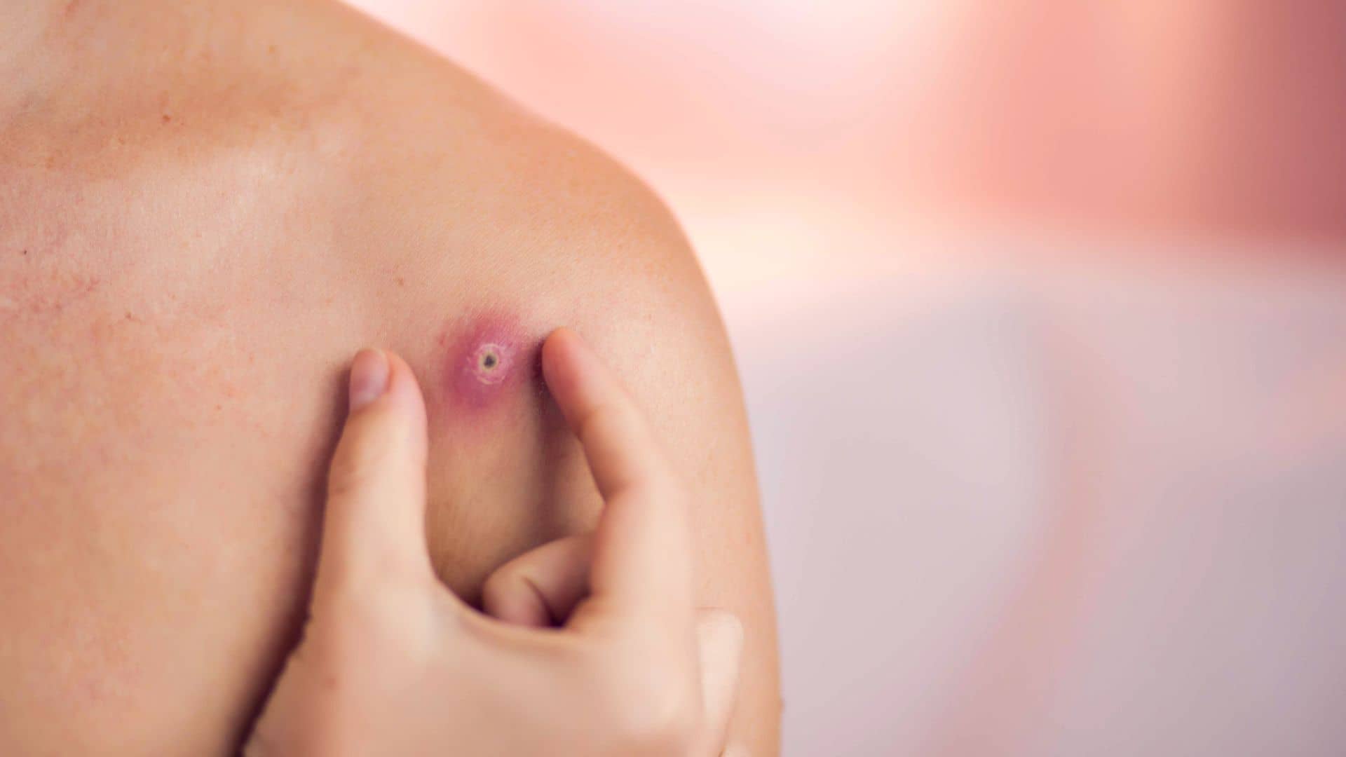 Difference Between Lumps, Swelling, and Pimples: When to See a Doctor