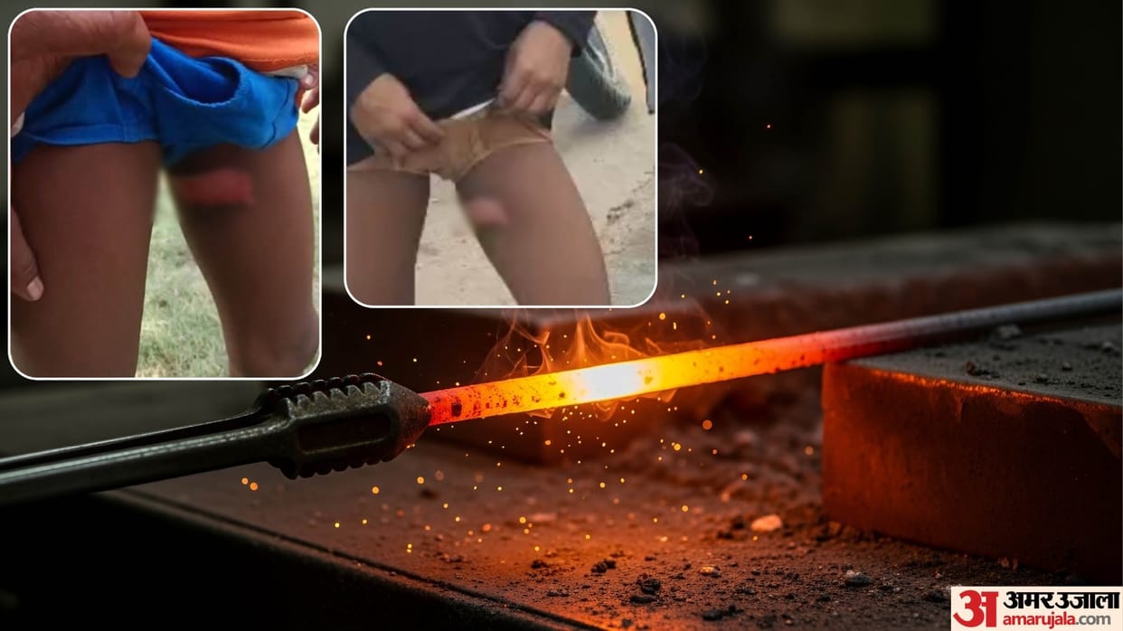 Barmer Children Brutally Tortured in Hostel, Burned with Hot Iron Rods Rajasthan Crime News