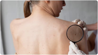 michael clarke skin cancer common in australia america know prevention tips in india