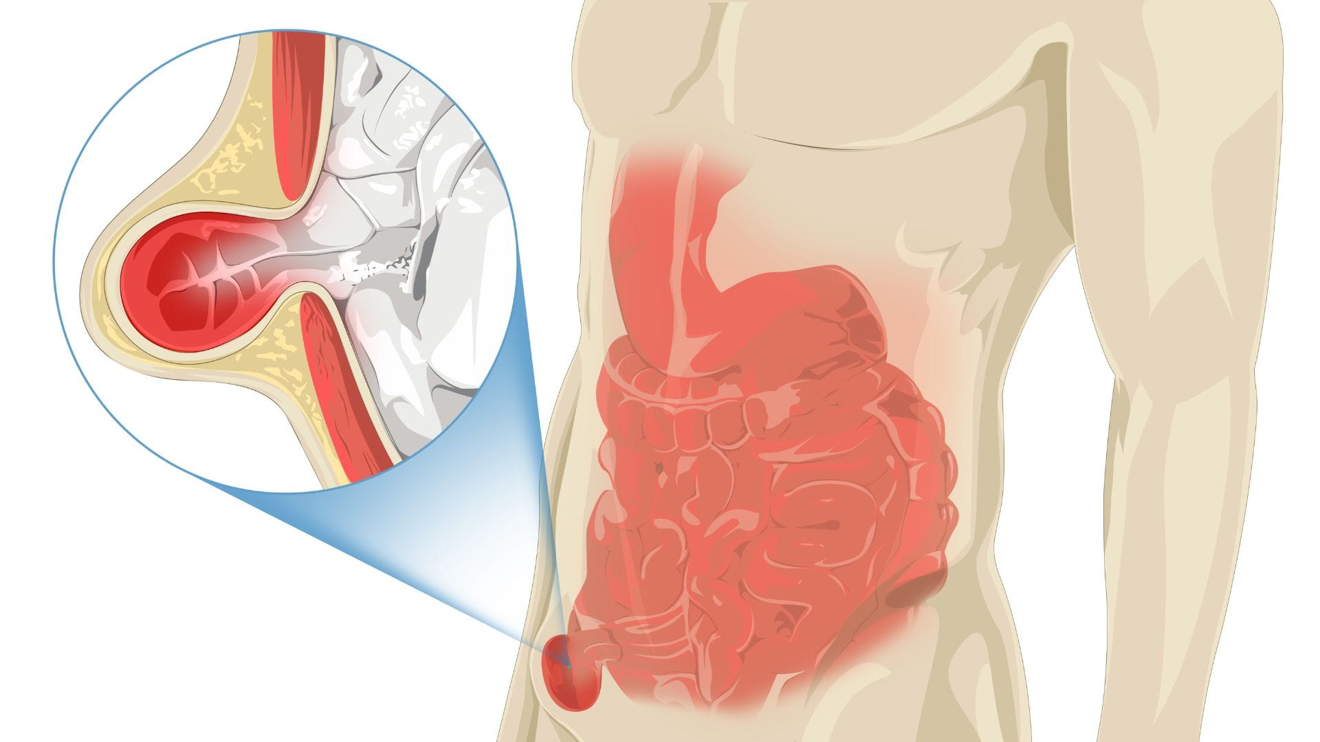 Due to these mistakes in daily routine the risk of hernia increases know in hindi