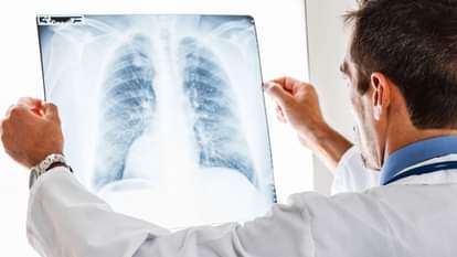 Health: Know these symptoms of pneumonia before you get affected