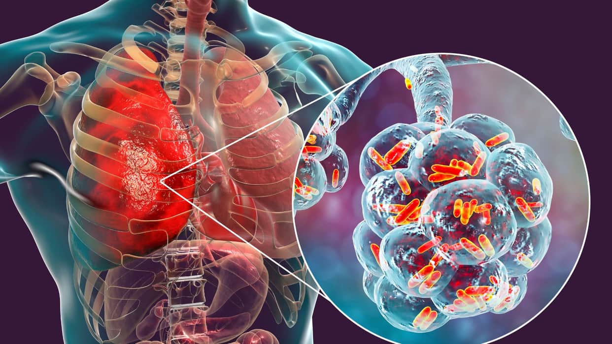 World Pneumonia Day 2025 Who is At Higher Risk And How To Prevent Health Tips