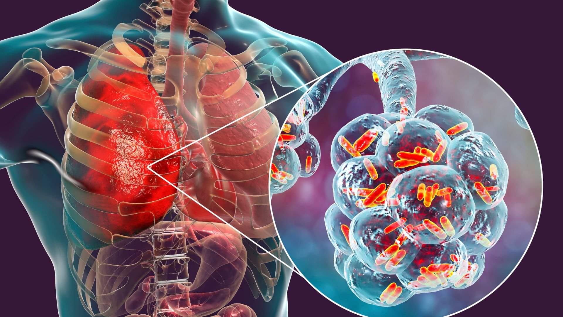 World Pneumonia Day 2025 Why is World Pneumonia Day celebrated about this year theme