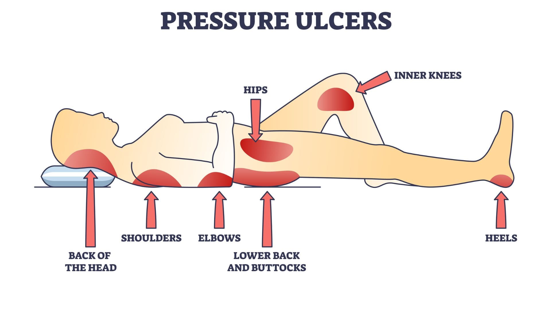Bedsores Common Mistakes That Increase Risk, Symptoms and Prevention Tips