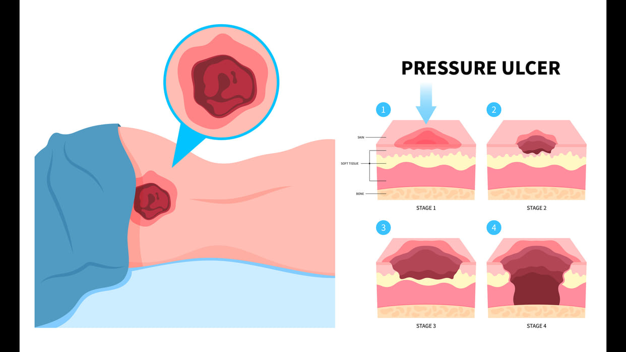 Bedsores Common Mistakes That Increase Risk, Symptoms and Prevention Tips