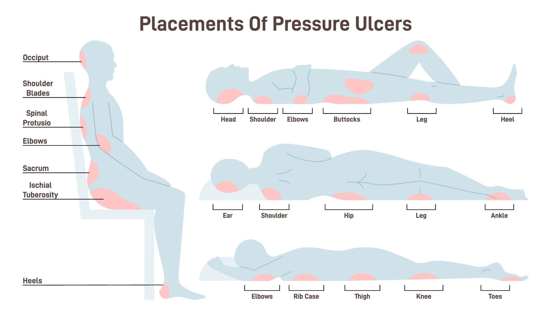 Bedsores Common Mistakes That Increase Risk, Symptoms and Prevention Tips