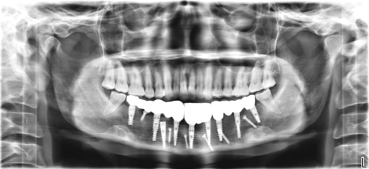 Bhopal: AIIMS made a new jaw from the bone of the leg, installed 13 teeth, the patient's jaw had to be cut due