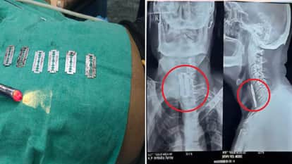 74 year old man swallowed six blades