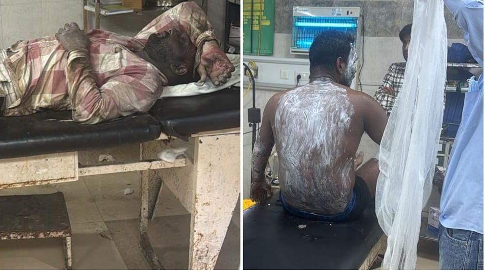 Four workers suffered burn injuries in a garment factory at Ambala