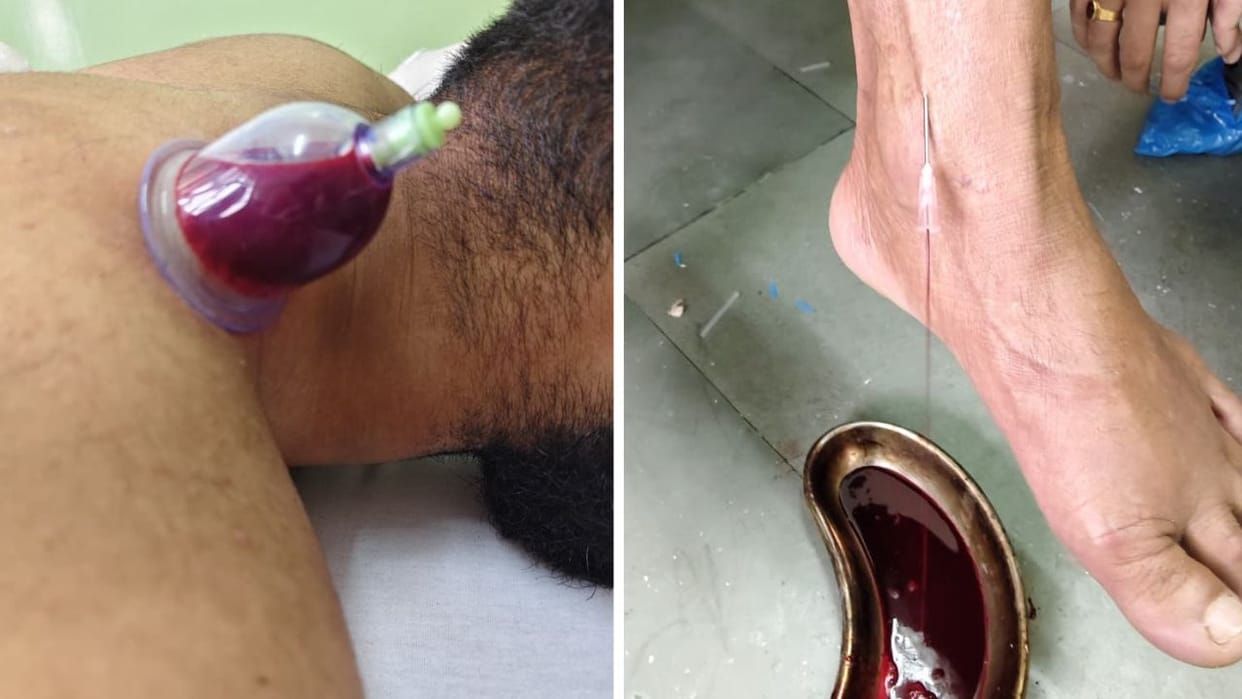 Ayurveda Day 2025 Thousands of years old medical system in Shimla is relieving patients pain
