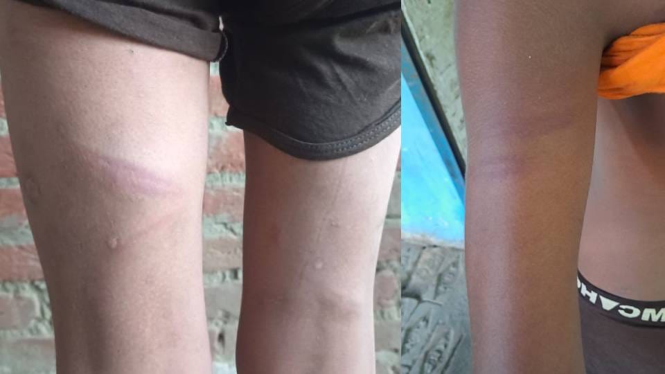 teacher brutally beats student with bamboo stick after he accidentally steps on classmate In Shravasti