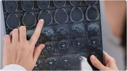 Hypertension may impair the brain far earlier than previously understood high blood pressure problems