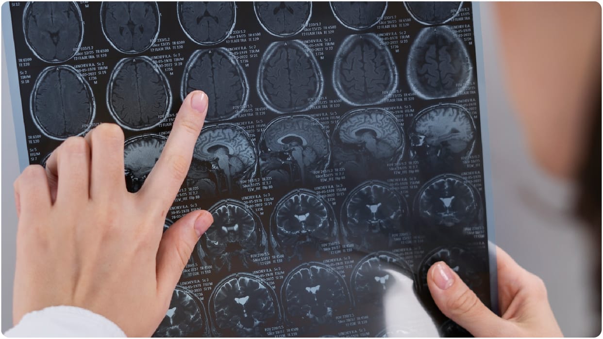 brain tumor causes and risk factors myths and facts about tumor in brain