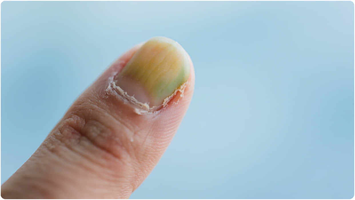 Brittle nails causes know What deficiency or diseases causes breaking of nails?
