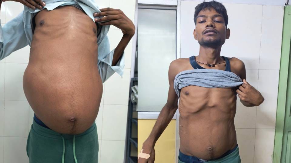 13 liters of water found in kidney Doctors at KGMU operated and saved 22-year-old man life