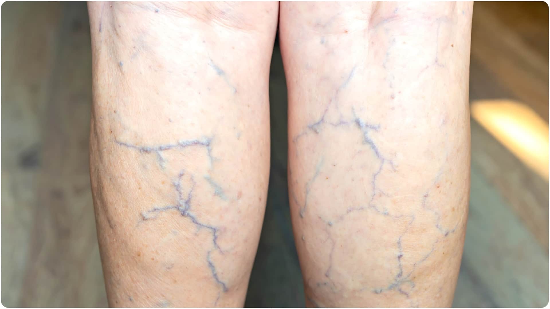 leg pain and swelling indicates health risks pairo me sujan ke lakshan