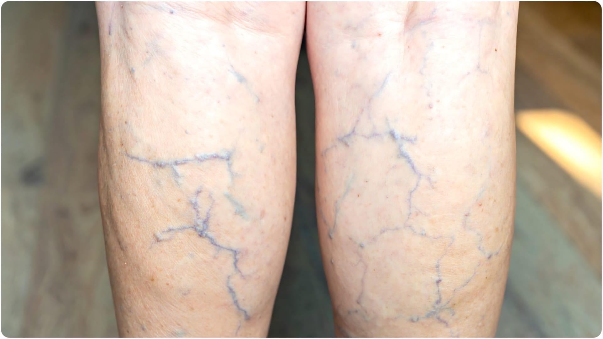 what causes blue spots on skin sign of disease know what is a blue spot on the skin