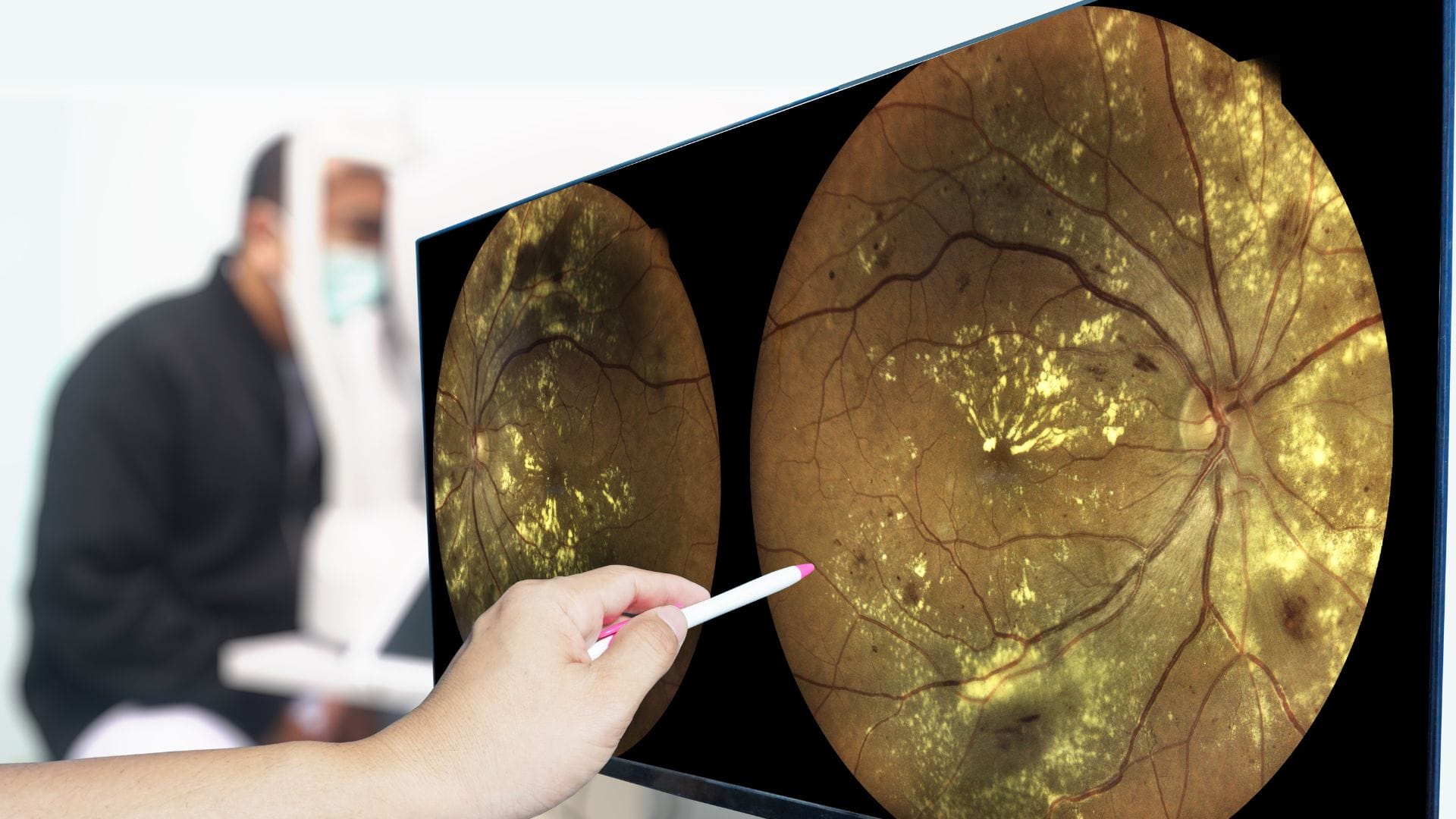 World Sight Day 2025 Why Diabetic Patients Are at Risk of Blindness Health Tips Explained diabetic retinopathy