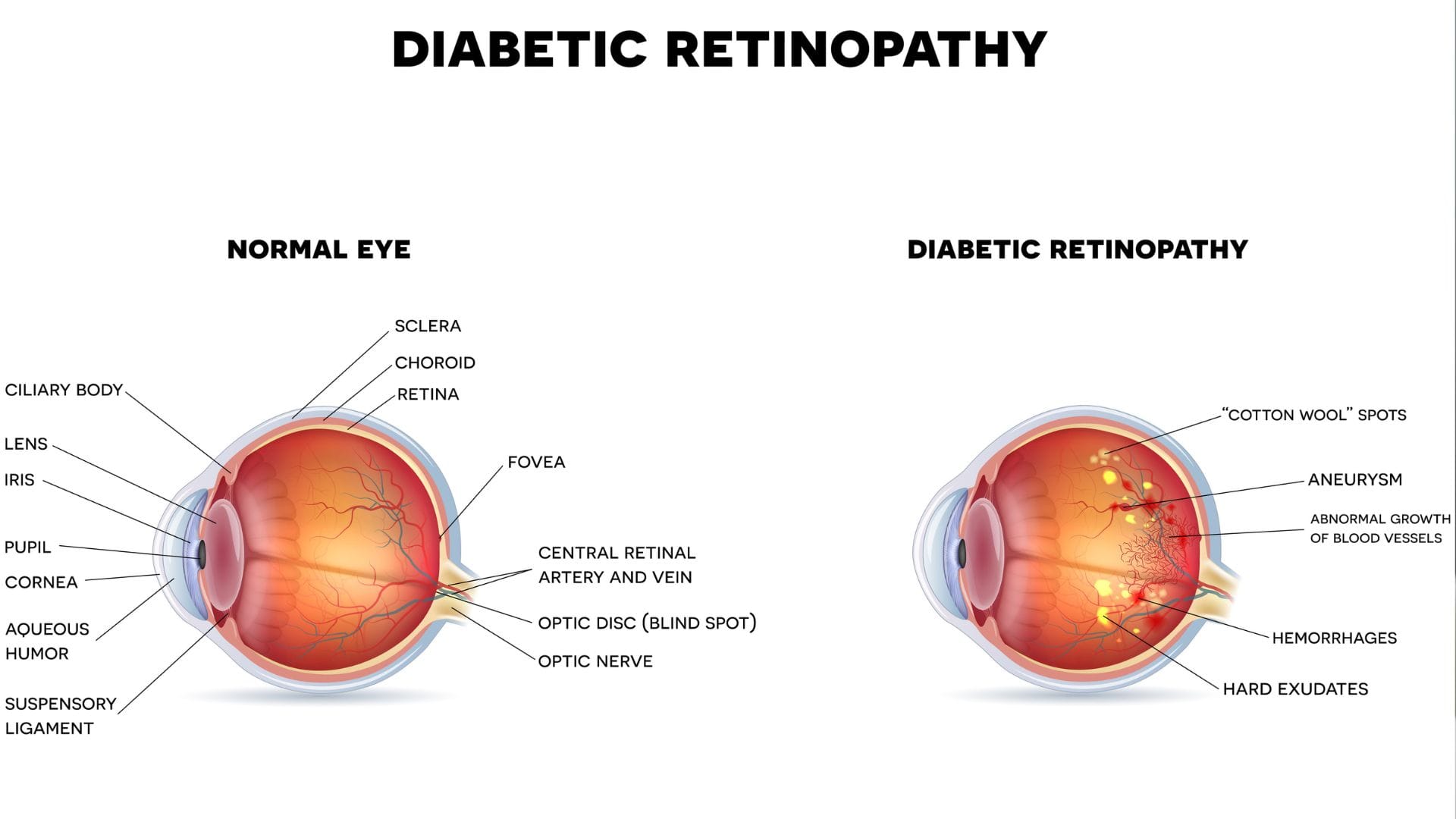 World Sight Day 2025 Why Diabetic Patients Are at Risk of Blindness Health Tips Explained diabetic retinopathy