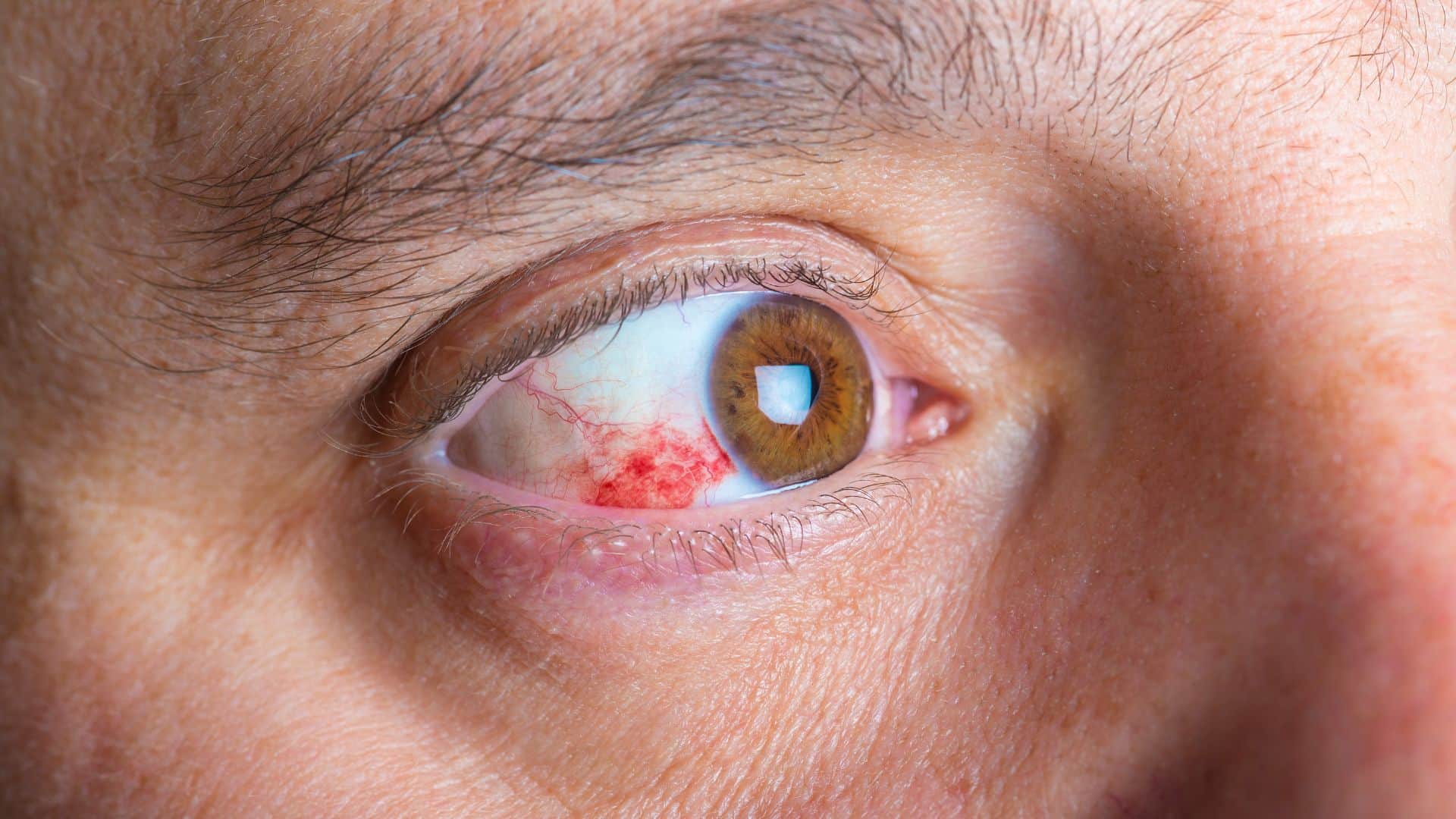 Emmanuel Macron appeared with puffy and extremely bloodshot eye know what is subconjunctival haemorrhage