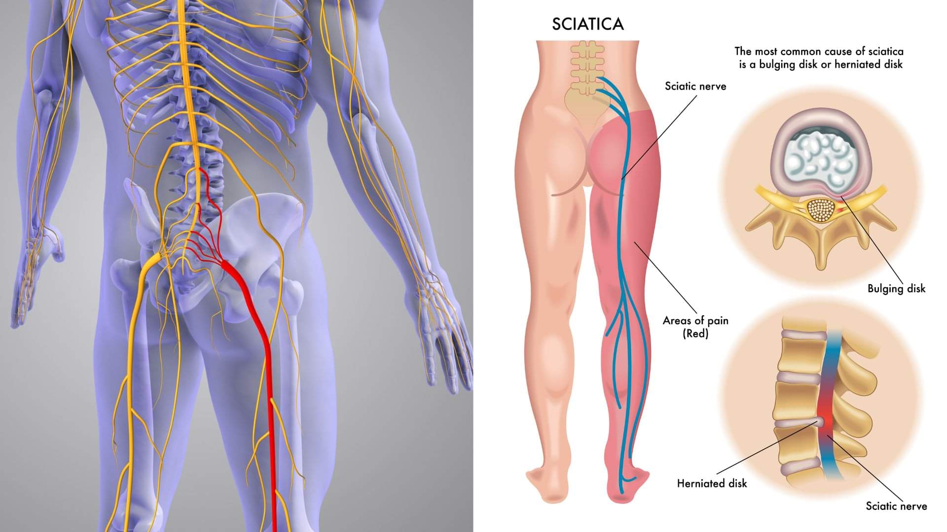 साइटिका, पैर में दर्द