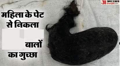 महिला के पेट से निकला बालों का गुच्छा