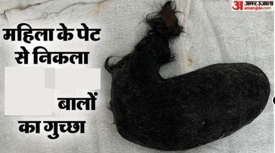Woman Suffers from Trichophagia for 50 Years 760g Hair Removed in Surgery