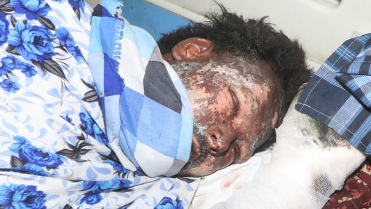 Kanpur: बम बनाते समय विस्फोट में अधेड़ के पंजे उड़े, 80 फीसदी झुलसा, धमाके से एक फिट का गड्ढा हुआ